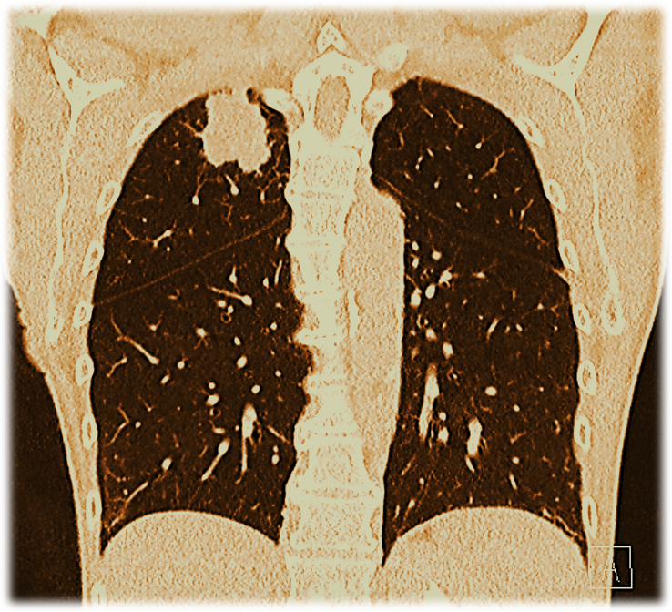 Fortbildung Lungenkrebs-Früherkennung für Zuweiser*innen